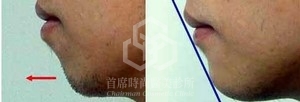 術後得到完美嘴唇與下巴尖切線