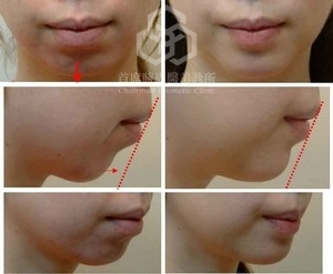 <另一個案> 圖左: 手術前; 圖右: 手術後